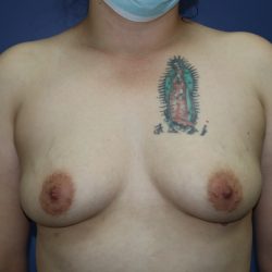 Breast Augmentation Before & After Patient #295