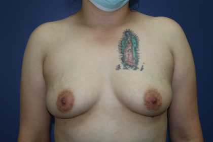 Breast Augmentation Before & After Patient #295