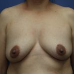 Breast Augmentation Before & After Patient #323