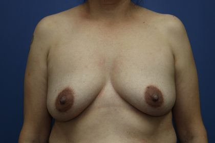 Breast Augmentation Before & After Patient #323