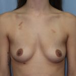 Breast Augmentation Before & After Patient #328