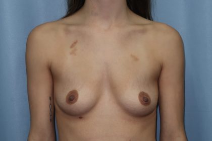 Breast Augmentation Before & After Patient #328