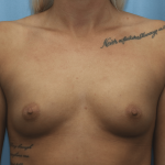 Breast Augmentation Before & After Patient #331