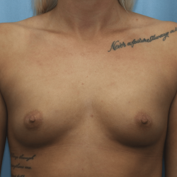 Breast Augmentation Before & After Patient #331