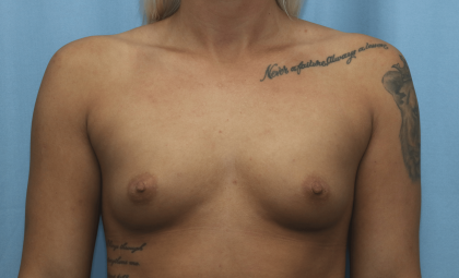 Breast Augmentation Before & After Patient #331
