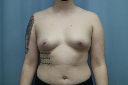 Breast Augmentation Before & After Patient #332