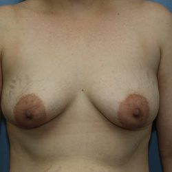 Breast Augmentation Before & After Patient #356