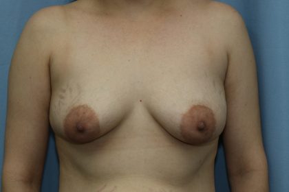 Breast Augmentation Before & After Patient #356