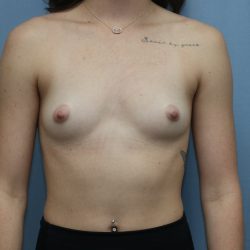 Breast Augmentation Before & After Patient #390