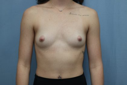 Breast Augmentation Before & After Patient #390