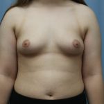 Breast Augmentation Before & After Patient #391