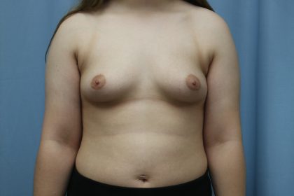 Breast Augmentation Before & After Patient #391