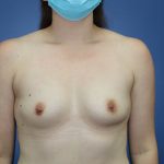 Breast Augmentation Before & After Patient #392