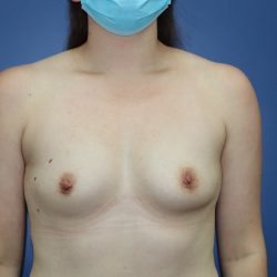 Breast Augmentation Before & After Patient #392