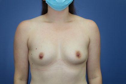 Breast Augmentation Before & After Patient #392