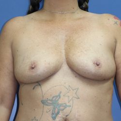 Breast Augmentation Before & After Patient #394