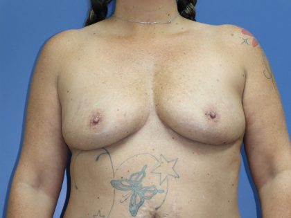 Breast Augmentation Before & After Patient #394
