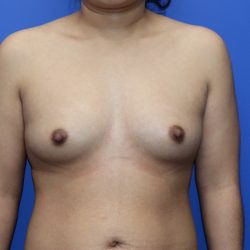 Breast Augmentation Before & After Patient #447