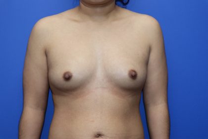 Breast Augmentation Before & After Patient #447