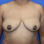 Breast Augmentation Before & After Patient #448