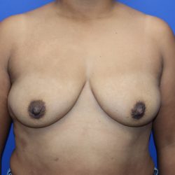 Breast Augmentation Before & After Patient #448