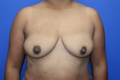 Breast Augmentation Before & After Patient #448