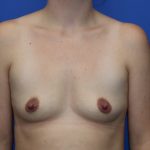 Breast Augmentation Before & After Patient #449