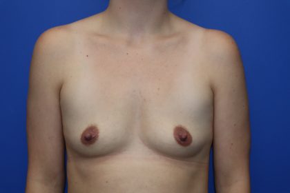 Breast Augmentation Before & After Patient #449