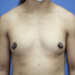 Breast Augmentation Before & After Patient #293