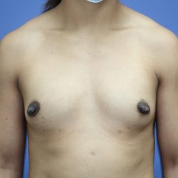 Breast Augmentation Before & After Patient #293