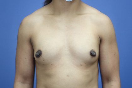 Breast Augmentation Before & After Patient #293