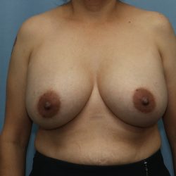 Breast Augmentation Before & After Patient #323