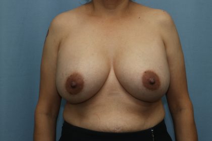 Breast Augmentation Before & After Patient #323