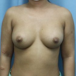 Breast Augmentation Before & After Patient #357