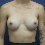 Breast Augmentation Before & After Patient #390