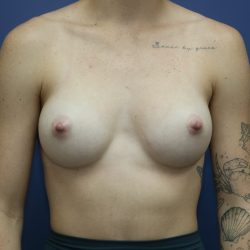Breast Augmentation Before & After Patient #390