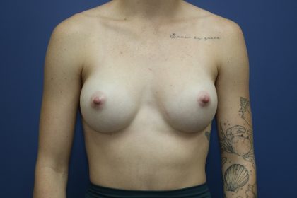 Breast Augmentation Before & After Patient #390