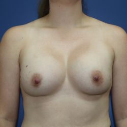 Breast Augmentation Before & After Patient #392