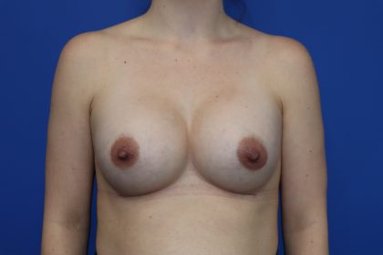 Breast Augmentation Before & After Patient #449
