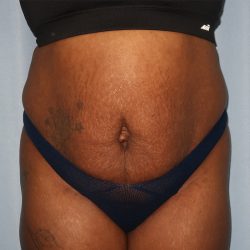 Tummy Tuck Before & After Patient #242