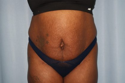 Tummy Tuck Before & After Patient #242