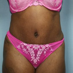 Tummy Tuck Before & After Patient #242