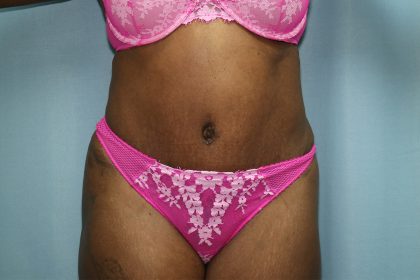Tummy Tuck Before & After Patient #242