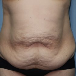 Tummy Tuck Before & After Patient #243