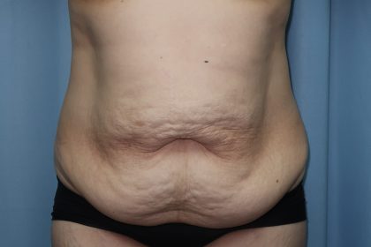 Tummy Tuck Before & After Patient #243