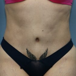 Tummy Tuck Before & After Patient #243