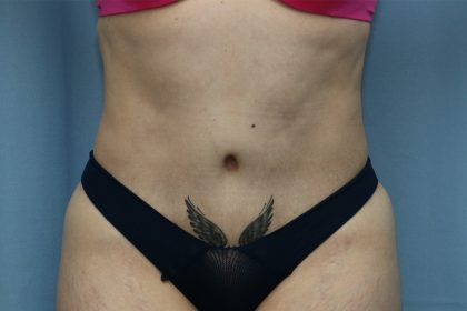 Tummy Tuck Before & After Patient #243