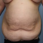 Tummy Tuck Before & After Patient #244