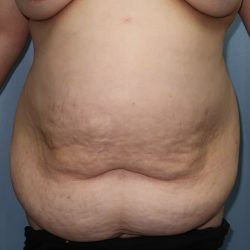 Tummy Tuck Before & After Patient #244