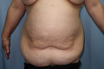 Tummy Tuck Before & After Patient #244